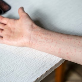 A teenager's hands covered in a measles rash.